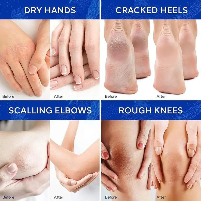 Urea Cream 42% Plus Salicylic Acid 4 Oz, Remover Dry Cracked Feet Hands