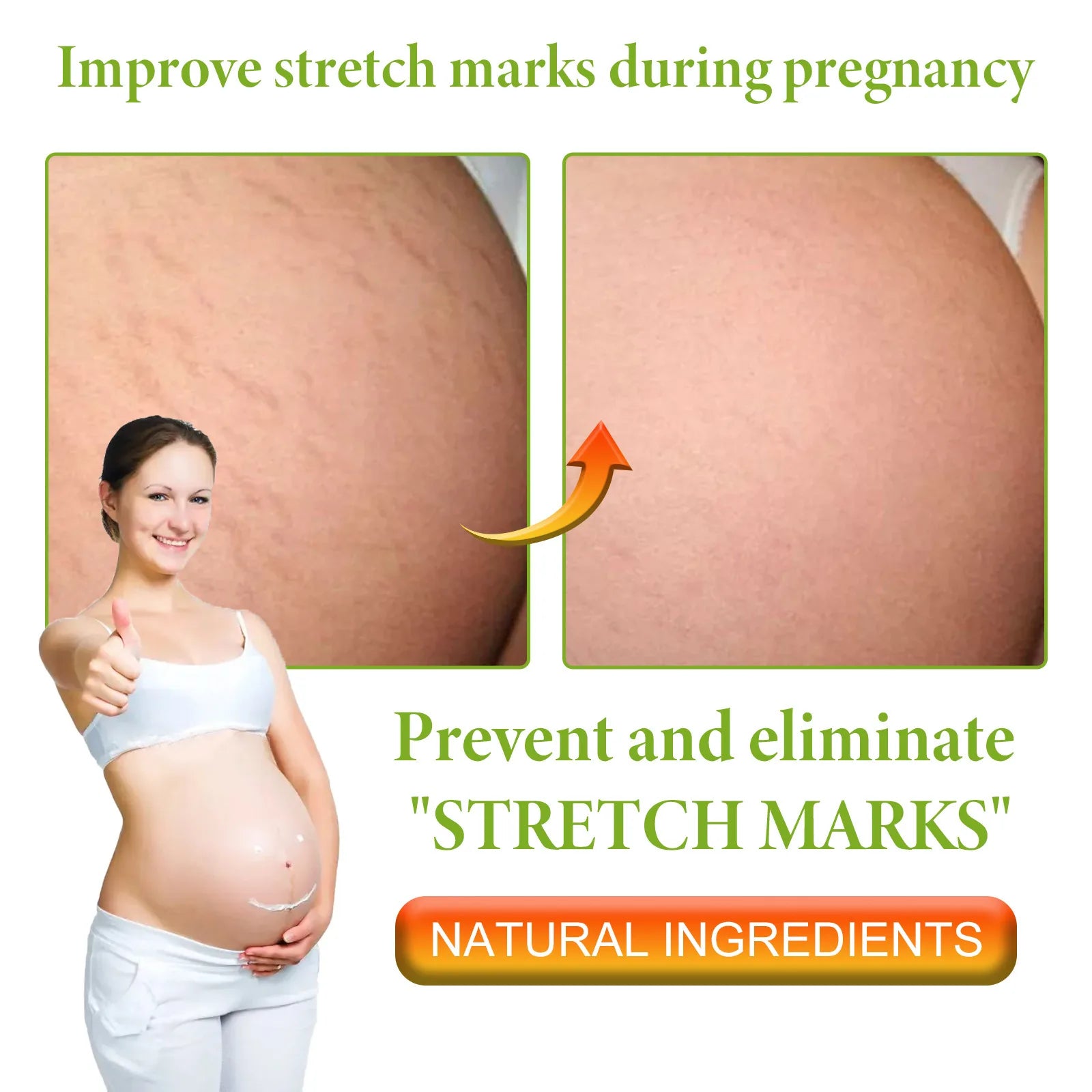 Anti Stretch Mark Cream for Pregnant Women Postpartum Obesity Repair Anti-Aging Anti-Winkles Medical Formula Smoothing Skin Care